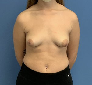 Breast-Augmentation--Case-Study-6914 | Before Breast Augmentation
